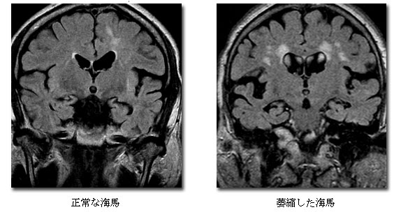 レントゲンで映し出された海馬の診断画像