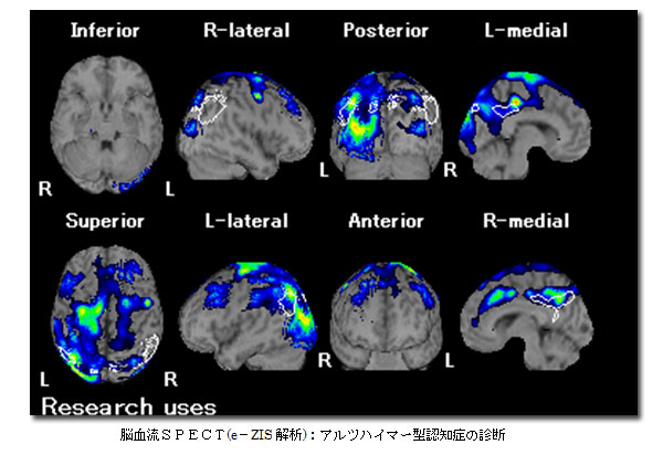 SPECT検査で診断されたアルツハイマー型認知症の診断画像